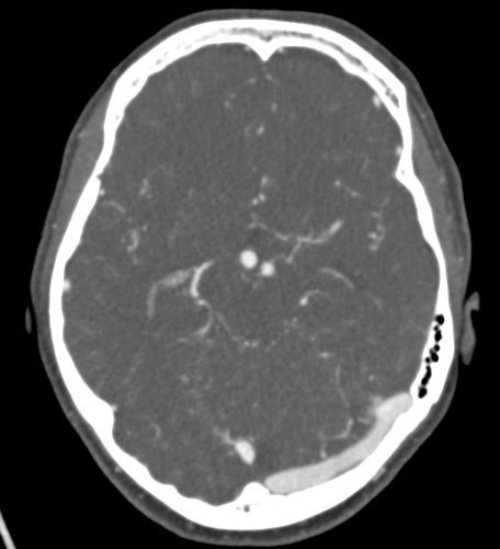 Basilar tip aneurysm with coiling (Radiopaedia 53912-60086 A 63).jpg