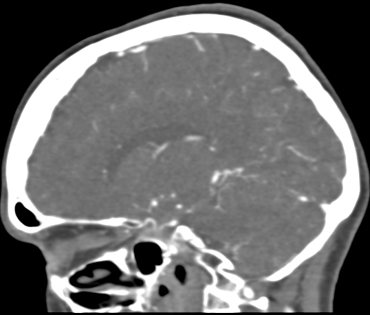 File:Basilar tip aneurysm with coiling (Radiopaedia 53912-60086 C 79).jpg