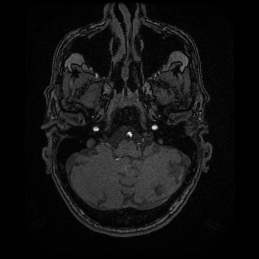 Basilar top and left middle cerebral artery aneurysm (Radiopaedia 61965-70031 Axial MRA 23).jpg