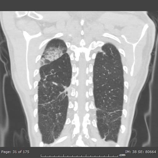 Behçet disease (Radiopaedia 44247-47889 Coronal lung window 5).jpg