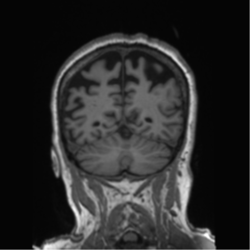 Behavioral variant frontotemporal dementia and late onset schizophrenia (Radiopaedia 52197-58083 Coronal T1 29).png