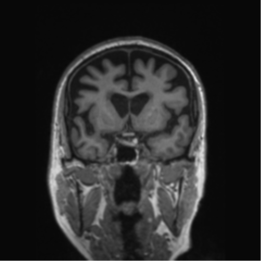 Behavioral variant frontotemporal dementia and late onset schizophrenia (Radiopaedia 52197-58083 Coronal T1 59).png