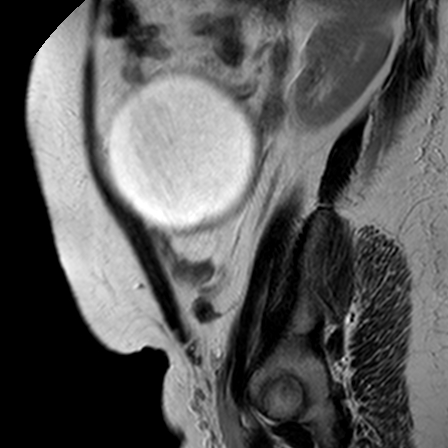 File:Benign seromucinous cystadenoma of the ovary (Radiopaedia 71065-81300 Sagittal T2 4).jpg