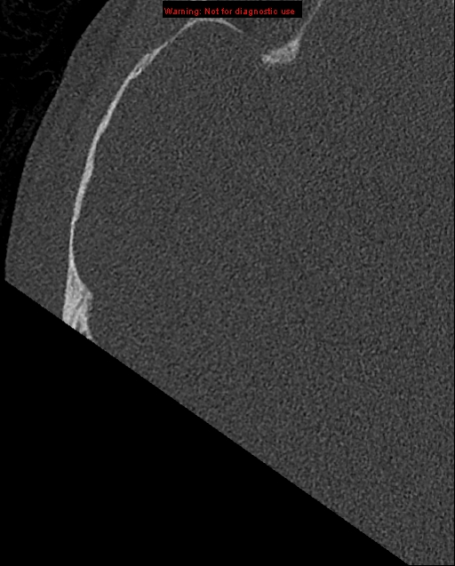 Bezold abscess (Radiopaedia 21645-21605 bone window 7).jpg