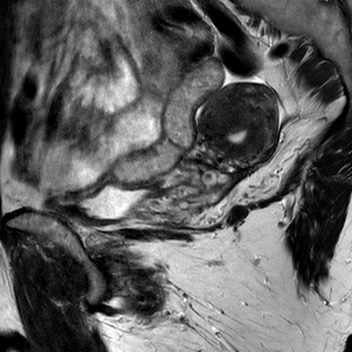 File:Bicornuate uterus (Radiopaedia 61974-70046 Sagittal T2 23).jpg