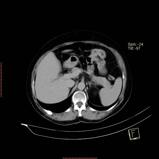File:Bifid ureter (Radiopaedia 47604-52253 Axial C+ delayed 4).jpg