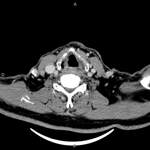 File:Bilateral Warthin tumors (Radiopaedia 84034-99263 Axial With contrast 46).jpg
