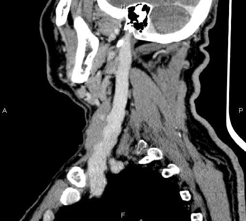 Bilateral Warthin tumors (Radiopaedia 84034-99263 D 28).jpg