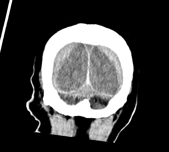 Bilateral acute on chronic subdural hematomas (Radiopaedia 78466-91146 Coronal non-contrast 61).jpg