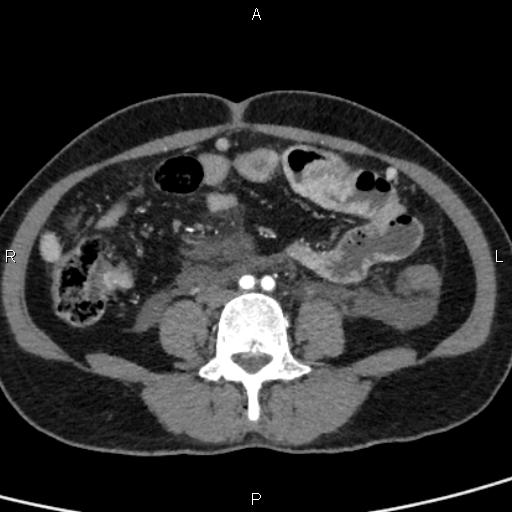 Bilateral adrenal gland hyperenhancement in pancreatitis (Radiopaedia 86642-102753 B 85).jpg