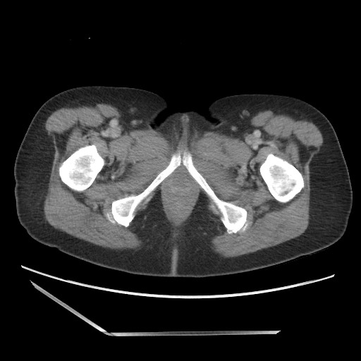File:Bilateral adrenal granulocytic sarcomas (chloromas) (Radiopaedia 78375-91007 A 126).jpg