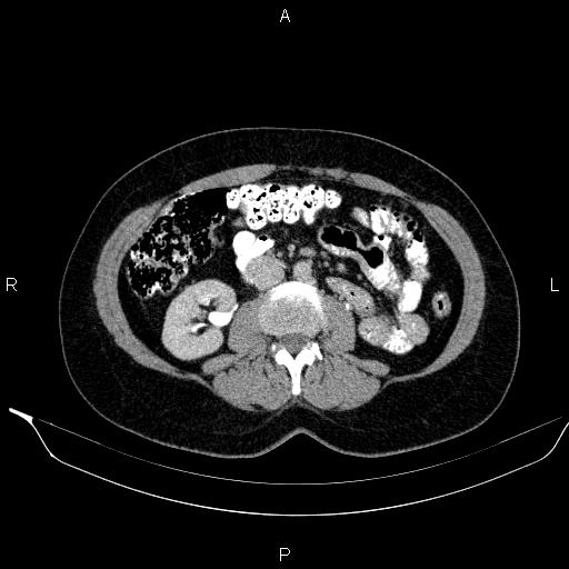 Bilateral adrenal myelolipoma (Radiopaedia 63058-71535 Axial C+ delayed 68).jpg