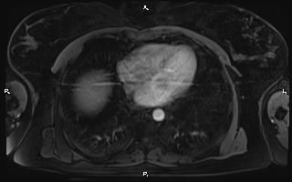 Bilateral adrenal myelolipoma (Radiopaedia 63058-71537 Axial T1 C+ fat sat 6).jpg