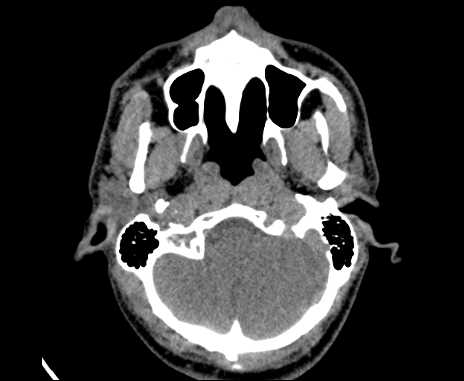 Bilateral carotid body tumors (Radiopaedia 61841-69870 Axial non-contrast 10).jpg