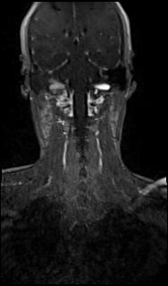 File:Bilateral carotid body tumors and right glomus jugulare tumor (Radiopaedia 20024-20060 MRA 52).jpg