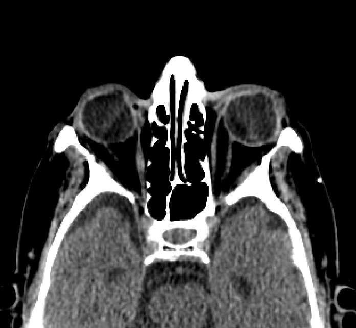 Bilateral ectopia lentis (Radiopaedia 89889-107013 Axial non-contrast 46).jpg