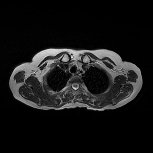 File:Bilateral elastofibromas dorsi (Radiopaedia 90158-107344 Axial T2 3).jpg