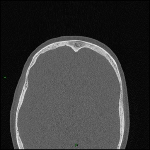 Bilateral frontal mucoceles (Radiopaedia 82352-96454 Axial bone window 72).jpg