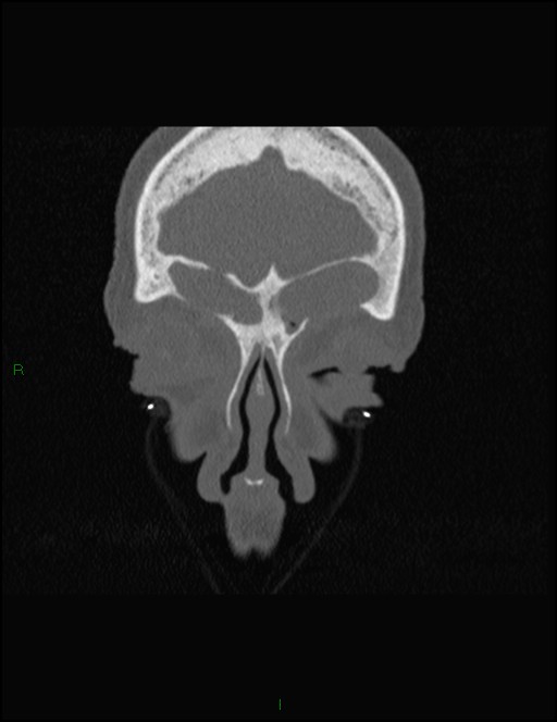 Bilateral frontal mucoceles (Radiopaedia 82352-96454 Coronal 64).jpg