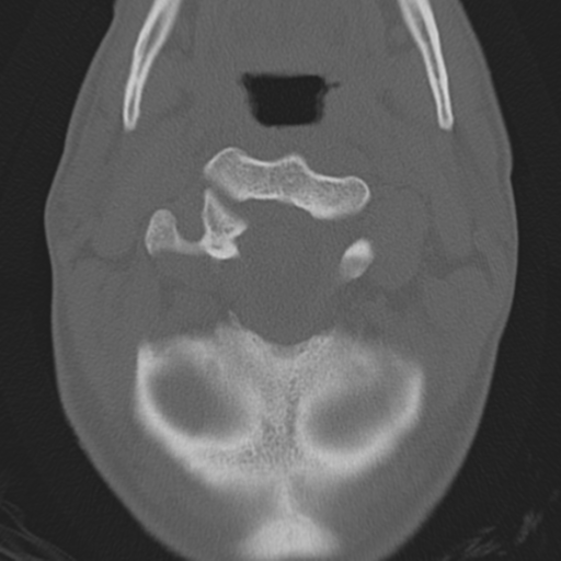File:Bilateral locked facets (Radiopaedia 33850-35016 Axial bone window 9).png
