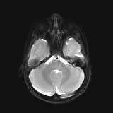 File:Bilateral mesial temporal polymicrogyria (Radiopaedia 76456-88181 Axial DWI 6).jpg