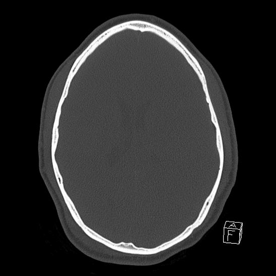 Bilateral occipital condyle fracture (type 2) (Radiopaedia 87675-104089 Axial bone window 82).jpg