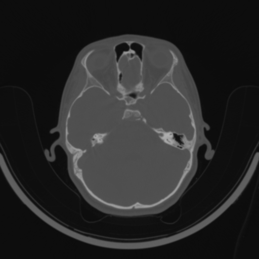 Bilateral otosclerosis (Radiopaedia 57237-64157 C 59).jpg
