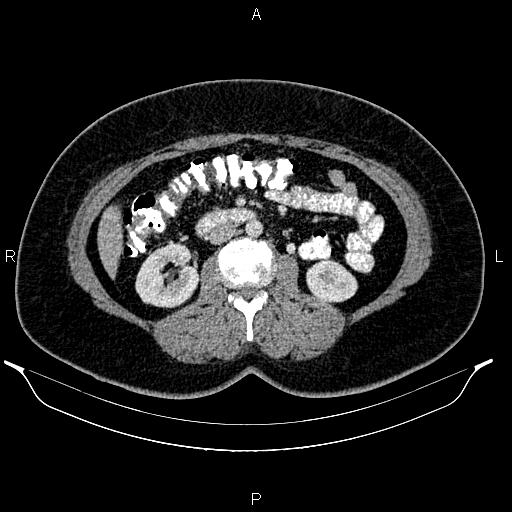 Bilateral ovarian dermoid cysts (Radiopaedia 85785-101603 A 52).jpg