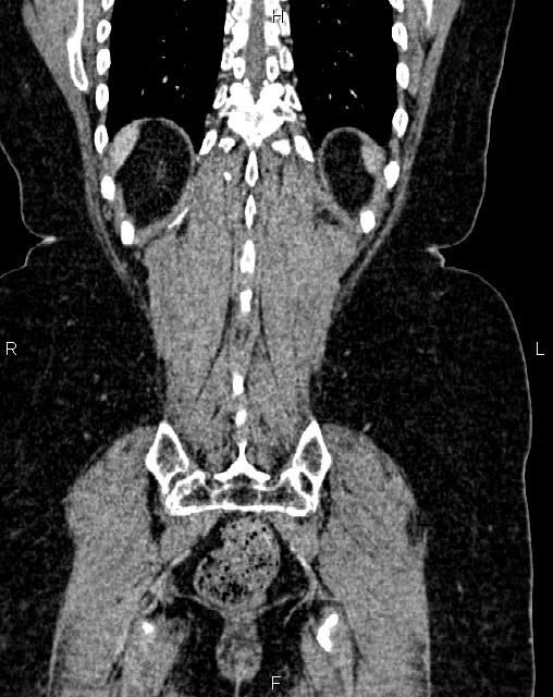 Bilateral ovarian serous cystadenocarcinoma (Radiopaedia 86062-101989 D 47).jpg
