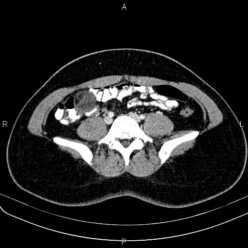 File:Bilateral ovarian teratoma (Radiopaedia 83131-97503 Axial With contrast 7).jpg