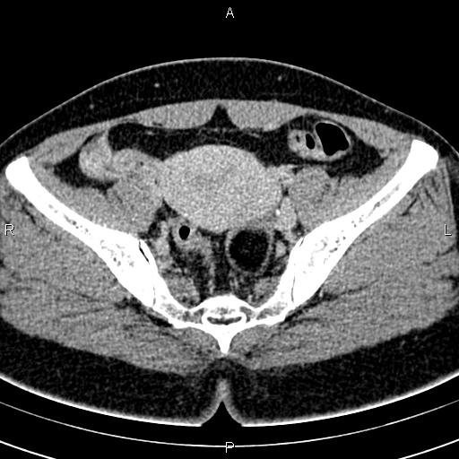 Bilateral ovarian teratoma (Radiopaedia 83131-97503 B 35).jpg