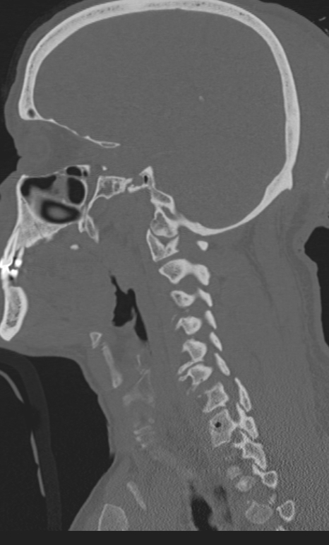 Bilateral perched facet joint (Radiopaedia 63149-71669 Sagittal bone window 47).jpg