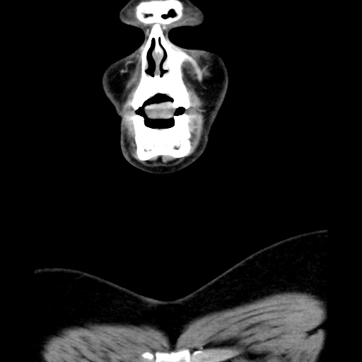 Bilateral peritonsillar abscess (Radiopaedia 85065-100610 Coronal 12).jpg