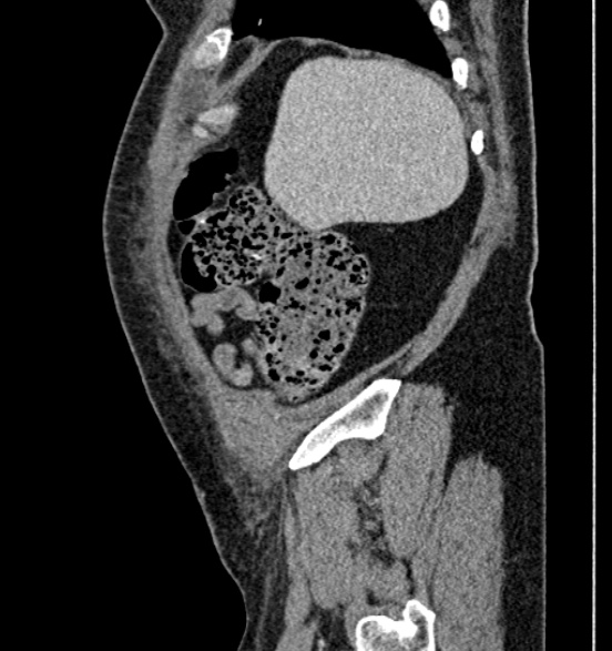 Bilateral rectus sheath hematomas (Radiopaedia 50778-56252 B 14).jpg
