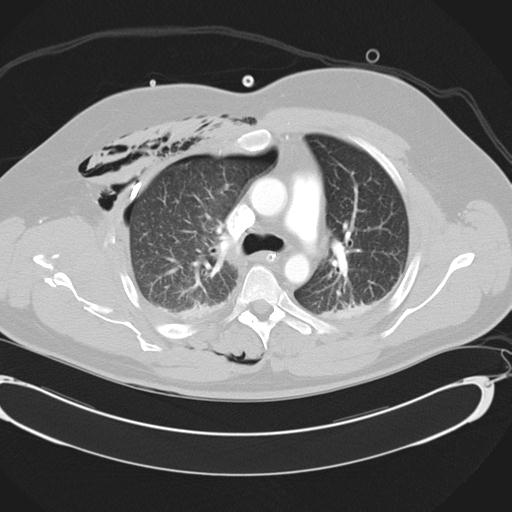 Bilateral traumatic renovascular injury (Radiopaedia 32051-32995 Axial lung window 20).jpg