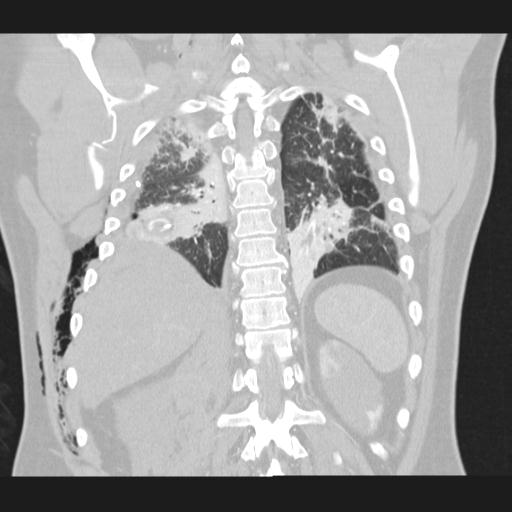 Bilateral traumatic renovascular injury (Radiopaedia 32051-32995 Coronal lung window 61).jpg