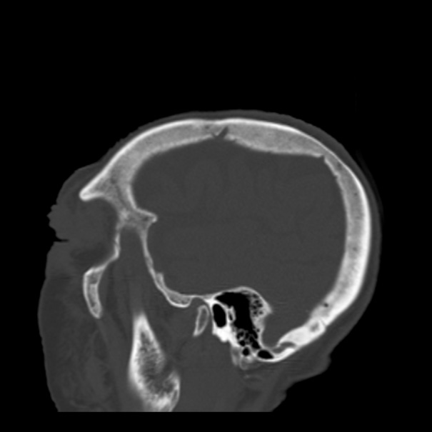 Biparietal osteodystrophy (Radiopaedia 46109-50463 Sagittal bone window 87).jpg