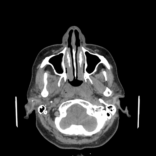 Bisphosphonate-related osteonecrosis of the jaw (Radiopaedia 71324-81642 non-contrast 133).jpg