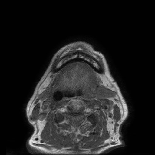 Bisphosphonate-related osteonecrosis of the maxilla (Radiopaedia 51367-57101 Axial T1 2).jpg