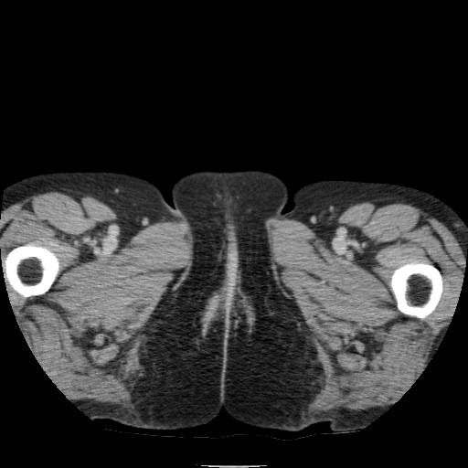Bladder tumor detected on trauma CT (Radiopaedia 51809-57609 C 156).jpg