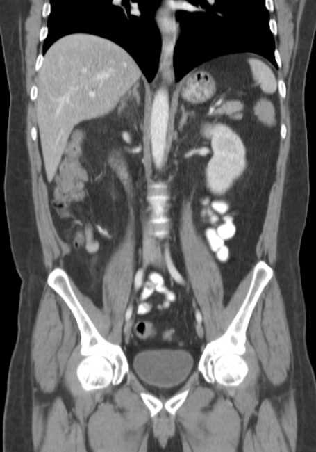Bleeding duodenal ulcer and adenomyomatosis of gallbladder (Radiopaedia 61834-69861 B 39).jpg