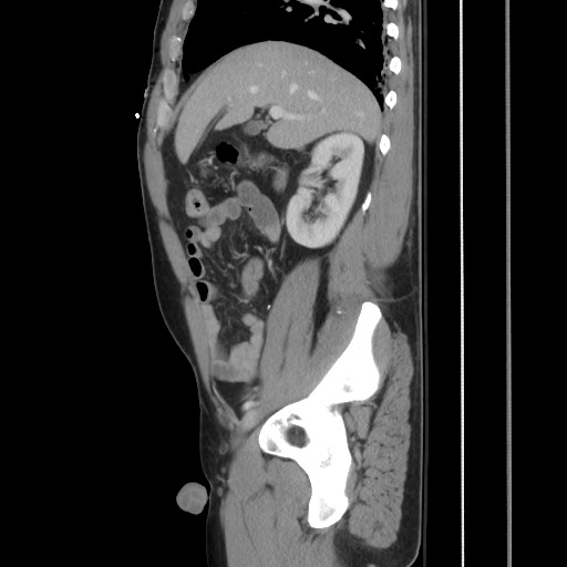 File:Blunt abdominal trauma with solid organ and musculoskelatal injury with active extravasation (Radiopaedia 68364-77895 C 53).jpg