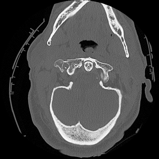 File:Blunt cerebrovascular injury (Radiopaedia 53682-59743 Axial bone window 15).png