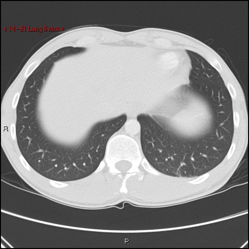 File:Blunt chest trauma - pulmonary interstitial emphysema and pneumomediastinum (Radiopaedia 20666-20552 Axial lung window 51).jpg