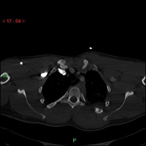 Blunt thoracic trauma (Radiopaedia 73454-84221 Axial bone window 21).jpg