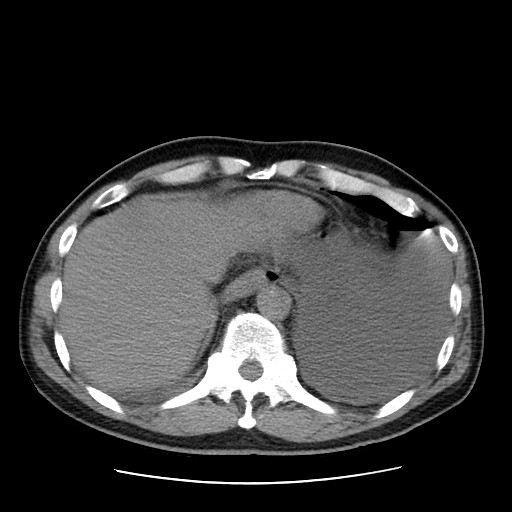 Boerhaave syndrome (Radiopaedia 59796-67310 Axial liver window 52).jpg