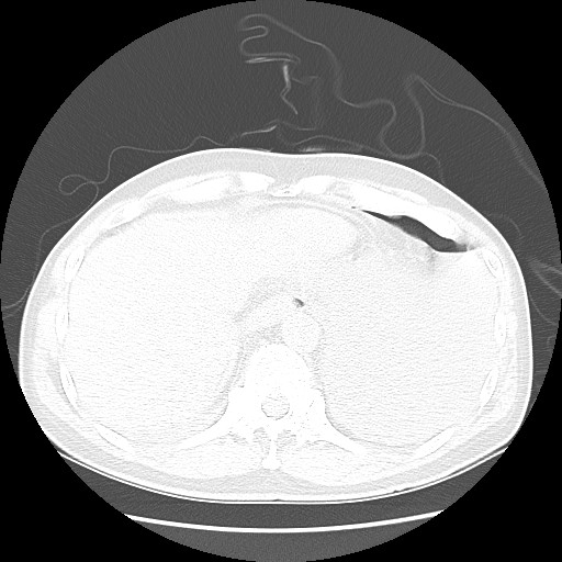 File:Boerhaave syndrome (Radiopaedia 59796-67310 Axial lung window 52).jpg