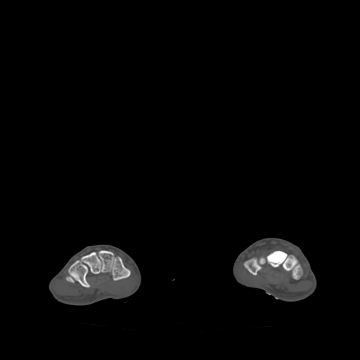 Bone islands - carpus (Radiopaedia 63141-71658 Axial bone window 35).jpg
