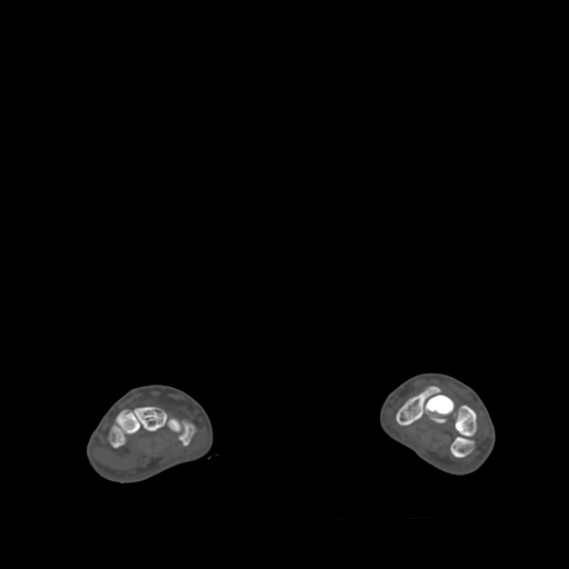 Bone islands - carpus (Radiopaedia 63141-71658 Axial bone window 44).jpg