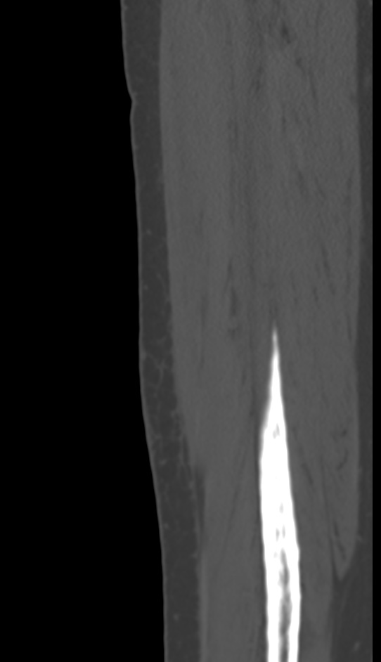 Bone metastasis - tibia (Radiopaedia 57665-64609 Sagittal bone window 147).jpg